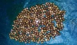 Phát hiện 360 viên sỏi “án ngữ” trong túi mật người phụ nữ